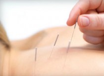 ACUPUNCTURE