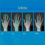 Arthritis Treatments