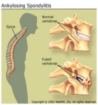 Arthritis Treatments