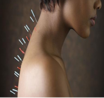 Acupuncture