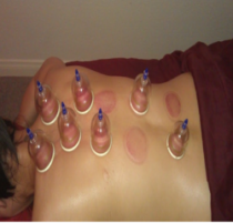 Cupping