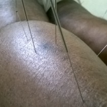 Acupuncture Treatment in Chennai