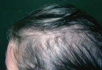 Hair Loss Treatment