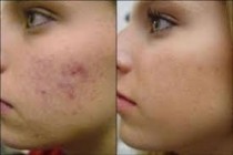 Pigmentation and Tan Removal