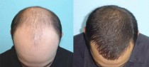 Hair Transplant