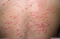 Psoriasis Treatment