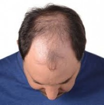 Baldness of Head