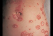 Psoriasis