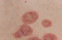 Lichen Planus Treatment