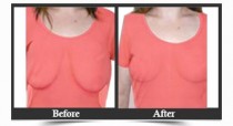 Breast Lift