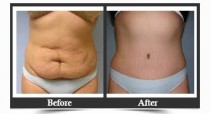 Tummy Tuck