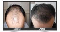 FUE Hair Loss Treatment