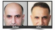 FUT And FUE Hair Loss Treatments