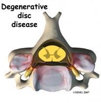 Disc Prolapse / Degeneration