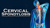 Spondylosis