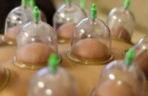 Cupping Therapy