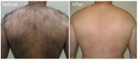 Laser Hair Removal Treatment