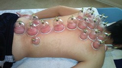 Cupping