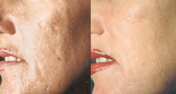 Microdermabrasion Treatment