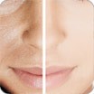 Pigmentation and Tan Removal