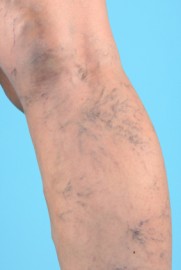 Varicose veins