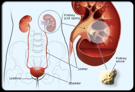 Ayurvedic treatment for Kidney stone