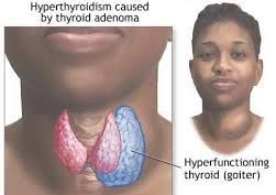 Hyperthyroidism