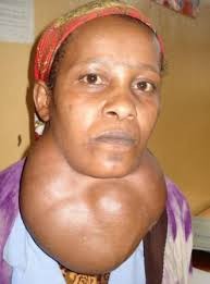 Goiter