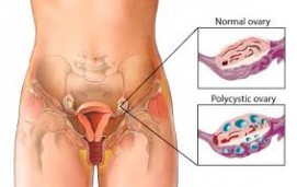 Polycystic ovarian Disease