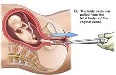 Spontanious Abortions (Repeated Abortions)