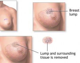 Breast Lump or cysts