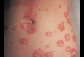 Psoriasis