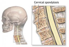 Spondylosis