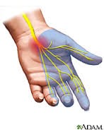 Carpal Tunnel Syndrome