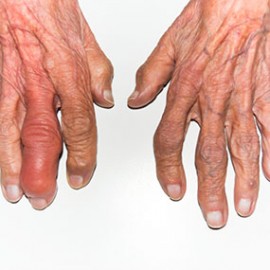 Rheumatoid Arthritis