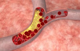 Cholesterol Problem (Increased Cholesterol Levels)