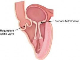 Rheumatic Heart Disease