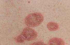 Lichen Planus Treatment