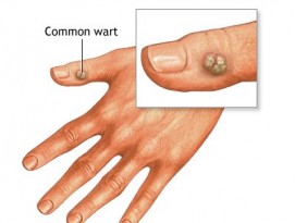 Warts Treatment