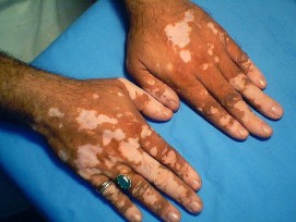 Vitiligo Treatment