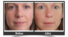 Facial Rejuvenation