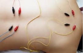 Electroacupuncture