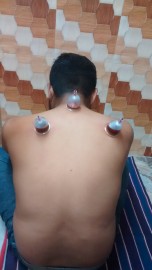 Hijama cupping therapy