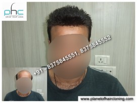 Non Surgical hair Replacement