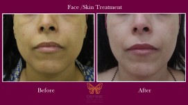 Acne Scar Treatment In Pune