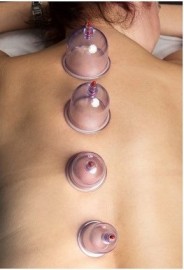 CUPPING THERAPY