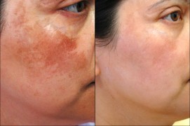 Pigmentation Therapy