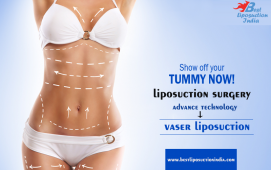 Liposuction Surgery in Delhi, India