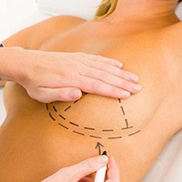 Breast Reduction/Lift Surgery in Delhi, India