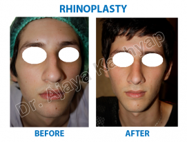 Rhinoplasty / Nose Surgery in Delhi